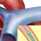 Heart stent medical illustration